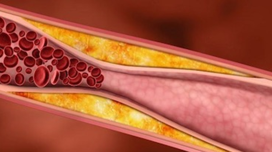 A qué puede conducir la aterosclerosis