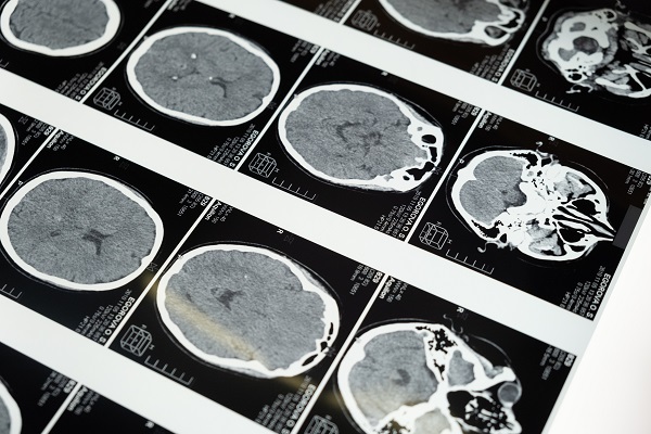 alimentos perjudiciales para el cerebro